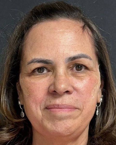 Depois dos fios de PDO: rosto mais simétrico, bochechas menos flácidas, bigode chinês menos marcado e contorno do rosto mais definido