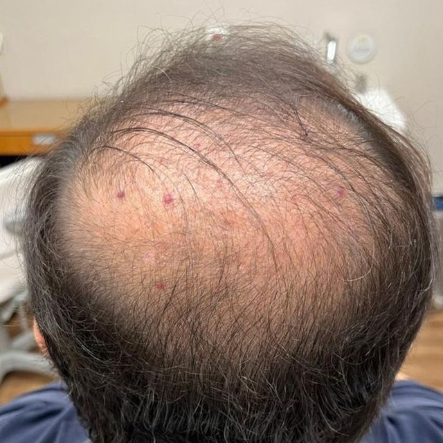 Antes da mesoterapia capilar: alto da cabeça de um paciente da Dra. Stephanie Mansan