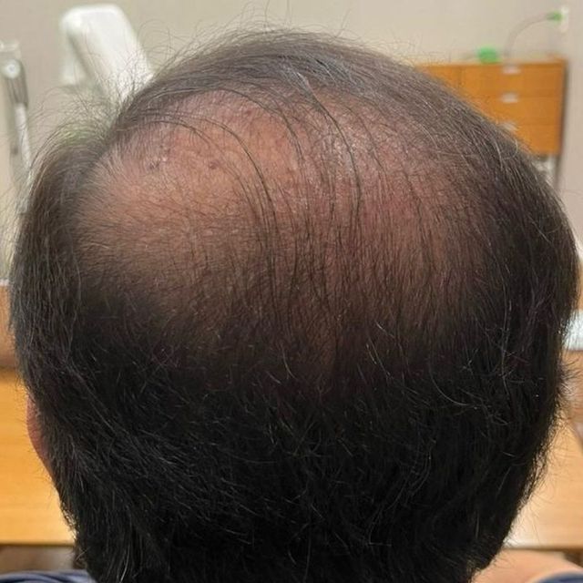 Um mês depois de começar a mesoterapia capilar: coroa mais cheia e couro cabeludo menos aparente