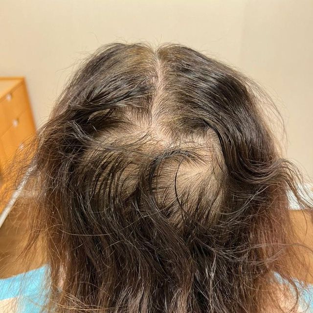 Antes do tratamento da queda de cabelo: couro cabeludo aparecendo no alto da cabeça de uma paciente
