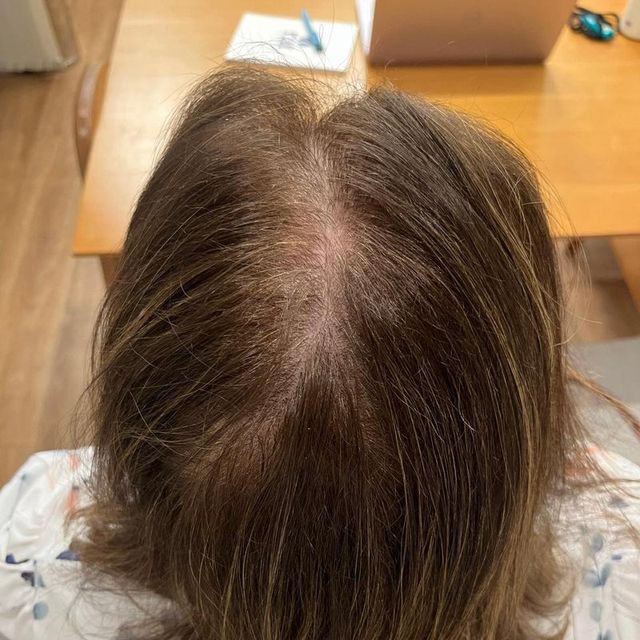 Quatro meses depois do tratamento da queda de cabelo: cabelo bem mais cheio