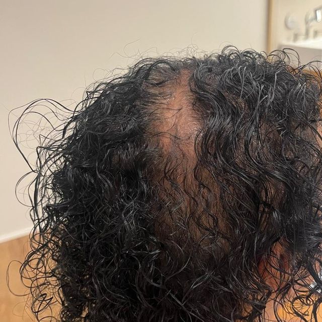 Antes do tratamento: cabelo cacheado com o couro cabeludo aparecendo no alto da cabeça, visto de costas
