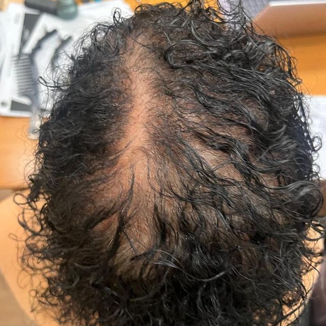 Antes do tratamento: cabelo cacheado visto de cima, com o couro cabeludo aparecendo