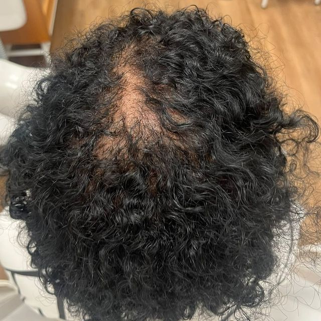 Seis meses depois do tratamento: cabelo cacheado visto de cima, com mais fios no alto da cabeça