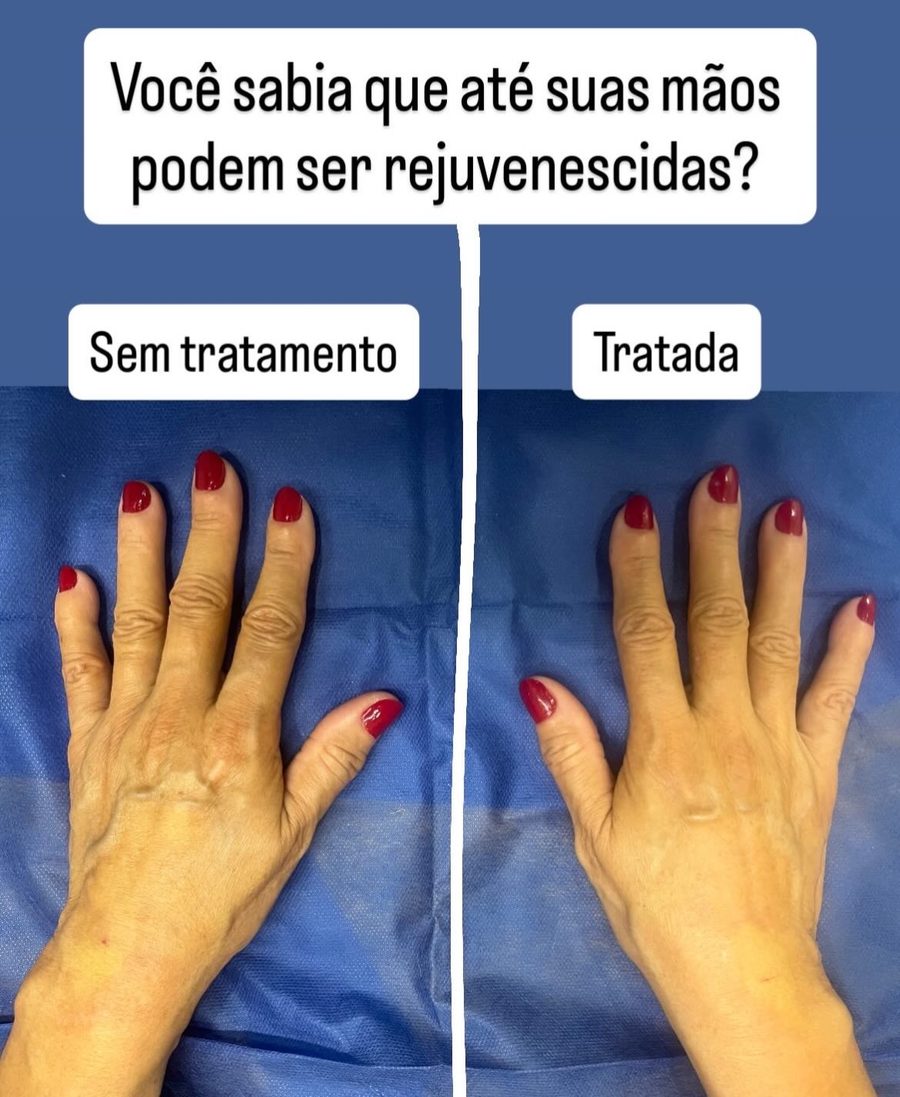 Mãos de uma paciente da Dra. Stephanie Mansan, lado a lado: à esquerda, sem tratamento, com pele fina, veias e tendões aparentes; à direita, tratadas, com o dorso das mãos mais cheio e uniforme